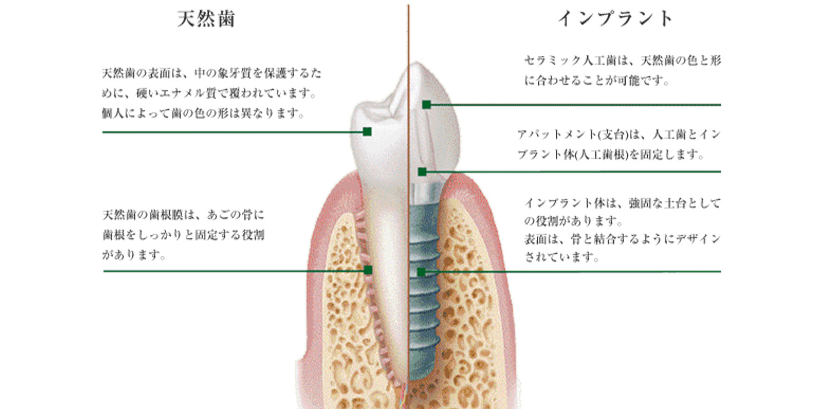 インプラントの説明の画像