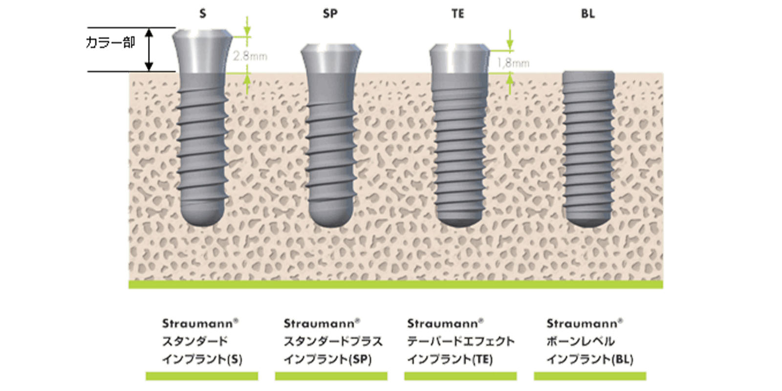 各インプラントの種類の説明