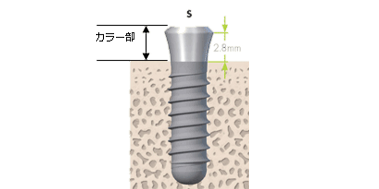 Straumannスタンダードインプラント（S）