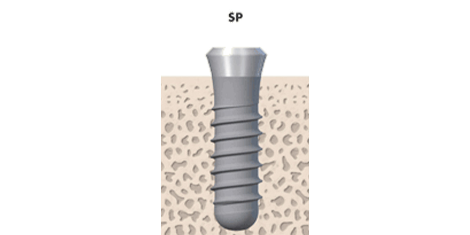 Straumannスタンダードプラスインプラント（SP）