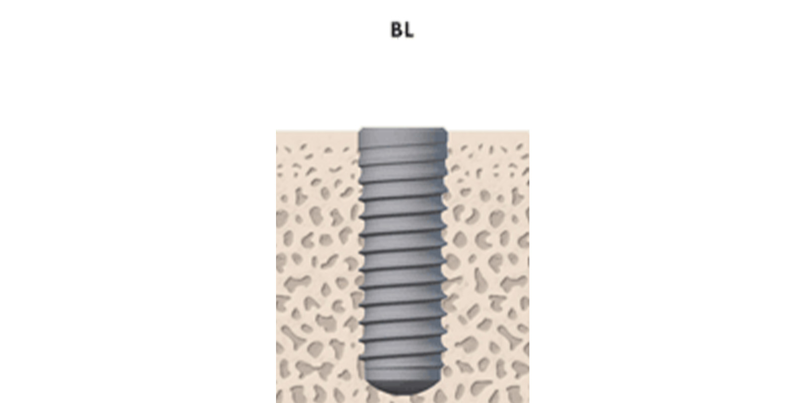 Straumannボーンレベルインプラント（BL）