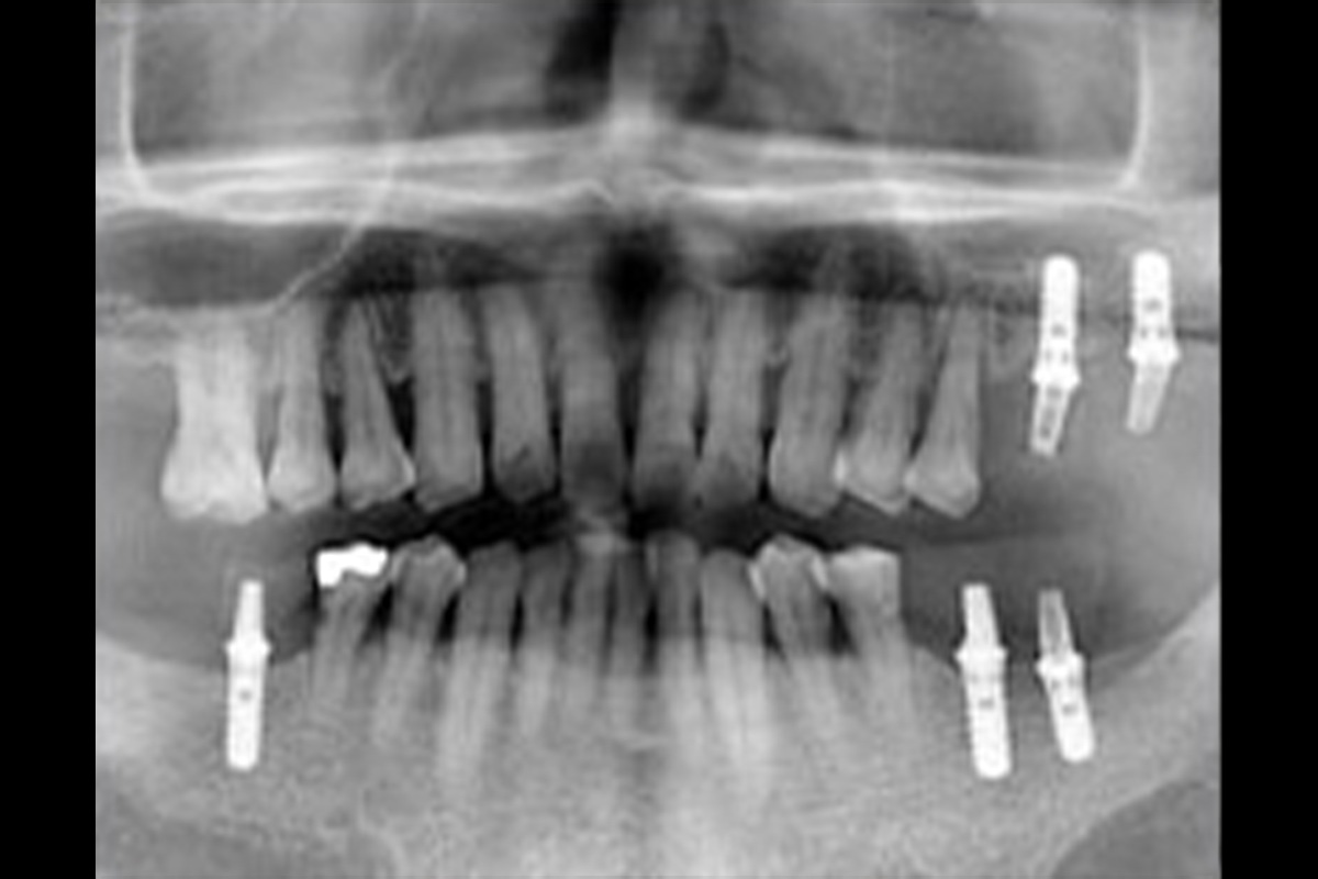 インプラント（レントゲン）