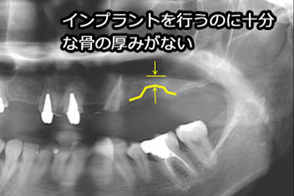 インプラント症例 術前